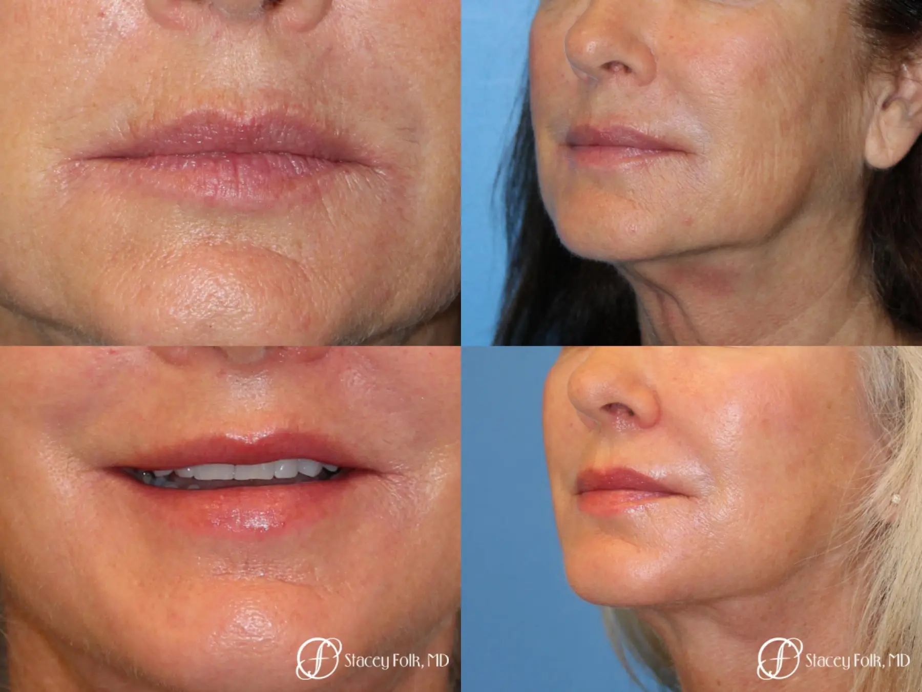 Denver Laser Skin Resurfacing Face 9390 - Before and After 1