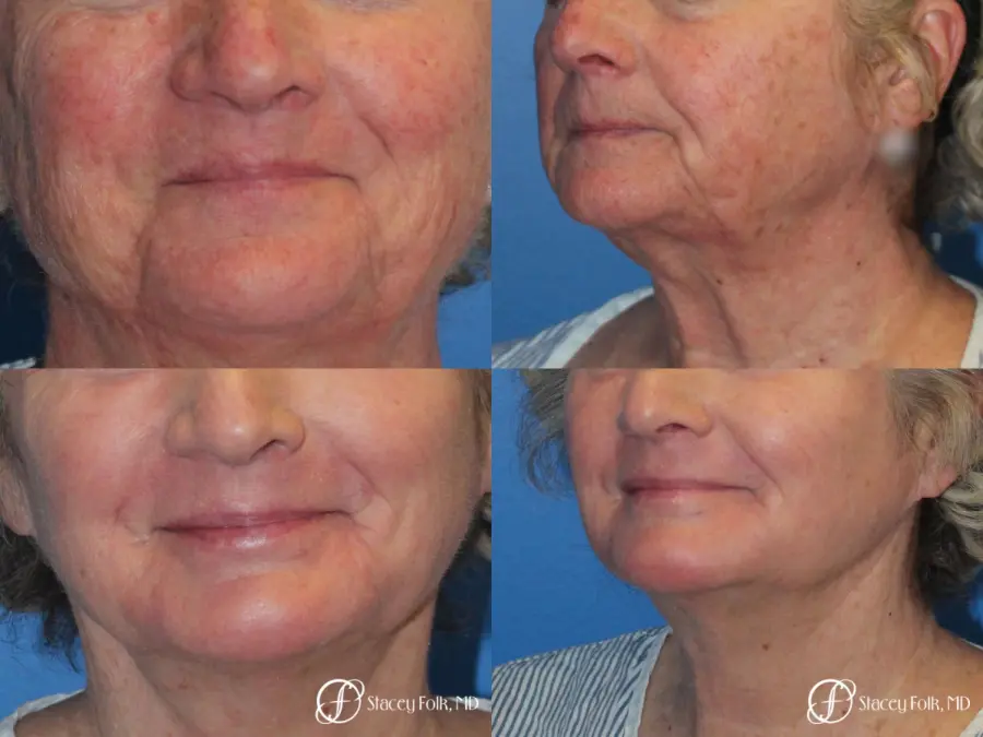 Denver Laser Skin Resurfacing Face 10665 - Before and After