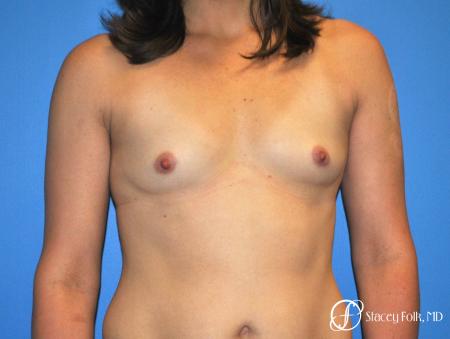 Denver Breast augmentation 7111 - Before Image 1