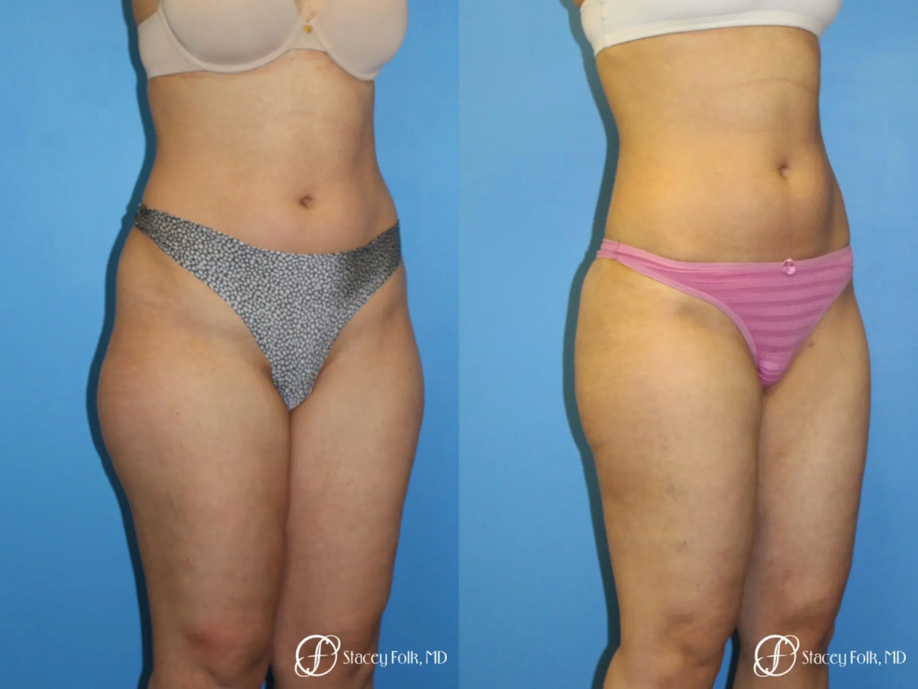 Denver Liposuction 8512 - Before and After 2