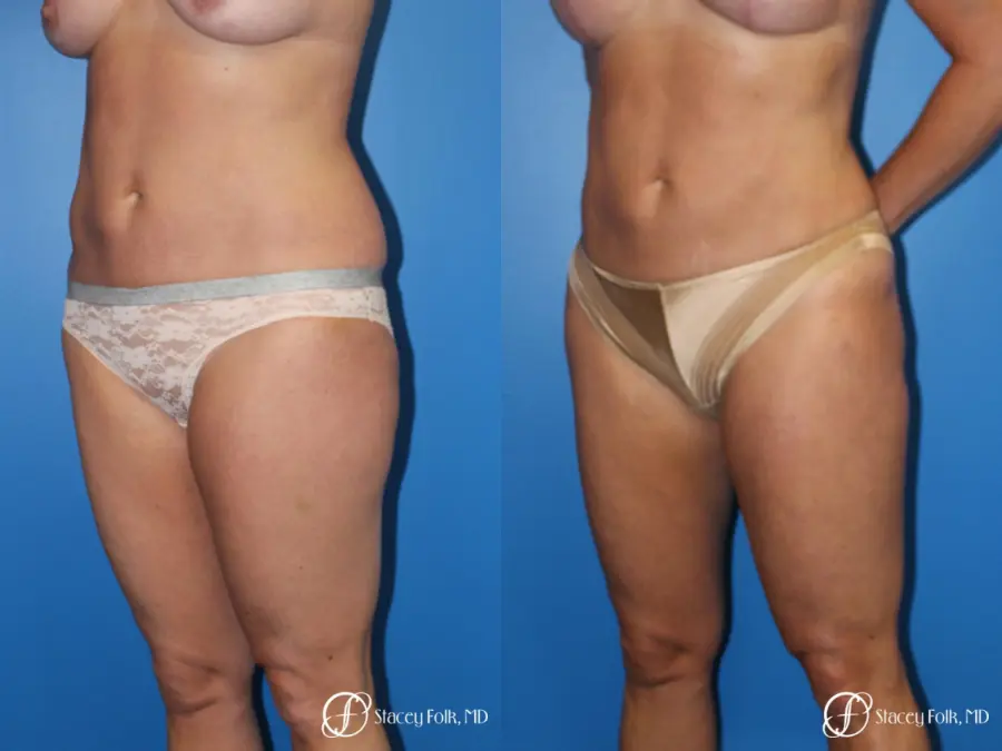 Denver Liposuction 10267 - Before and After 2
