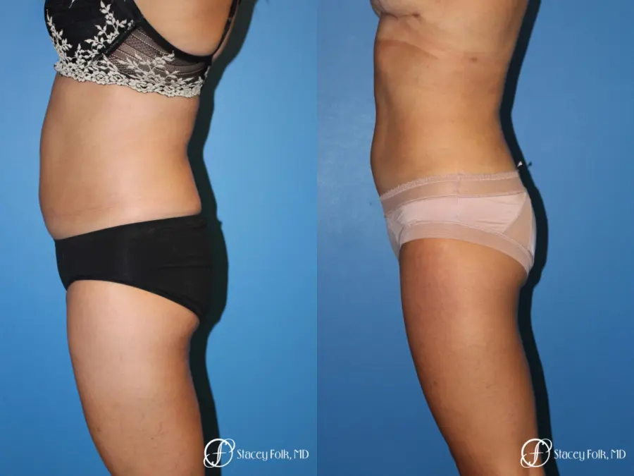 Liposuction - Before and After 2