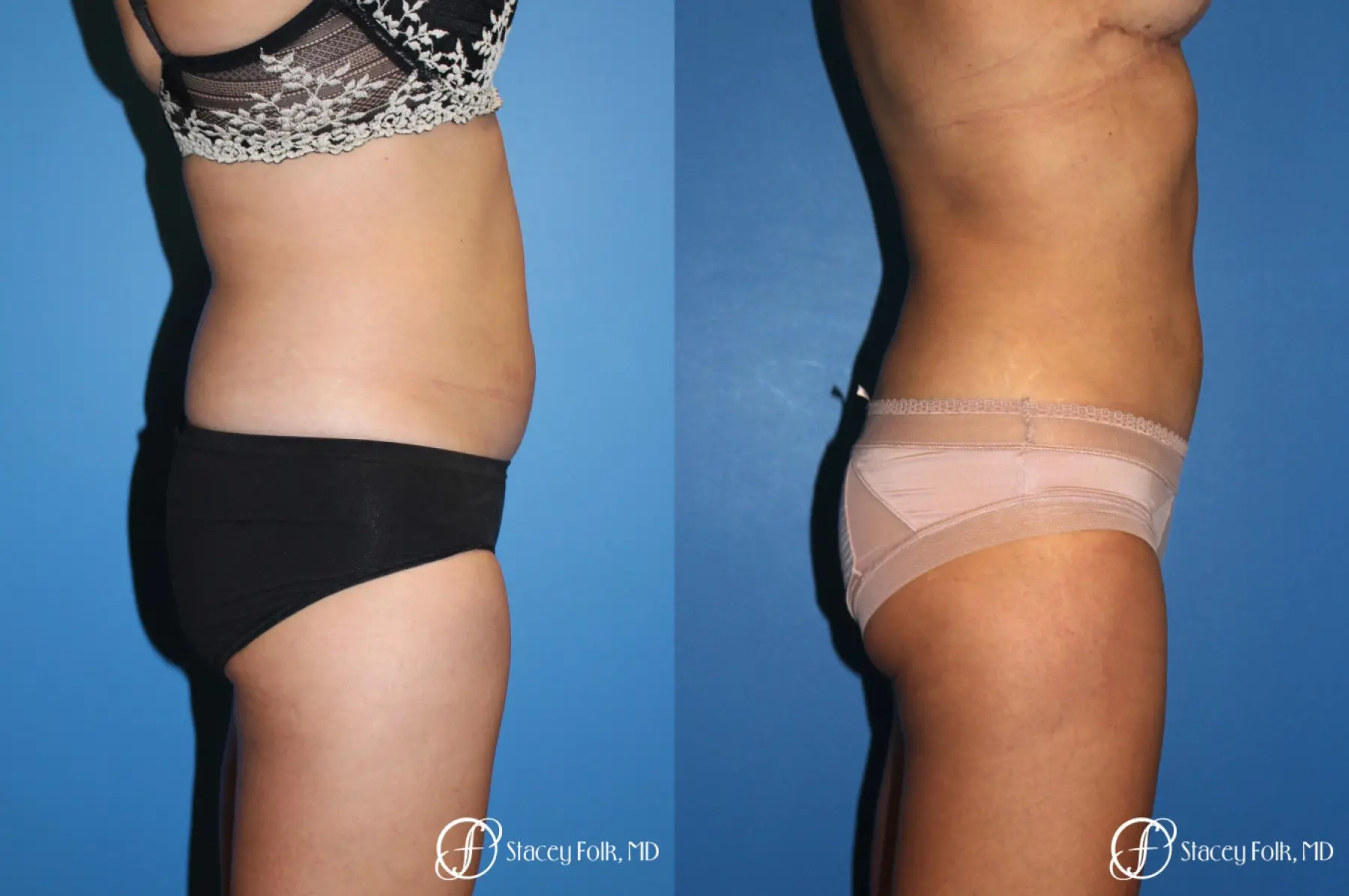 Liposuction - Before and After