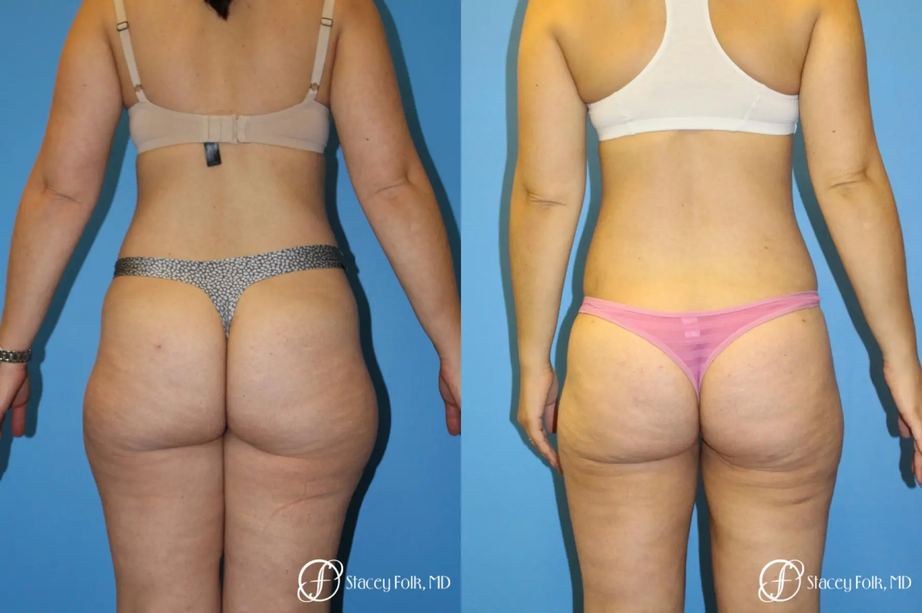 Denver Liposuction 8512 - Before and After 1