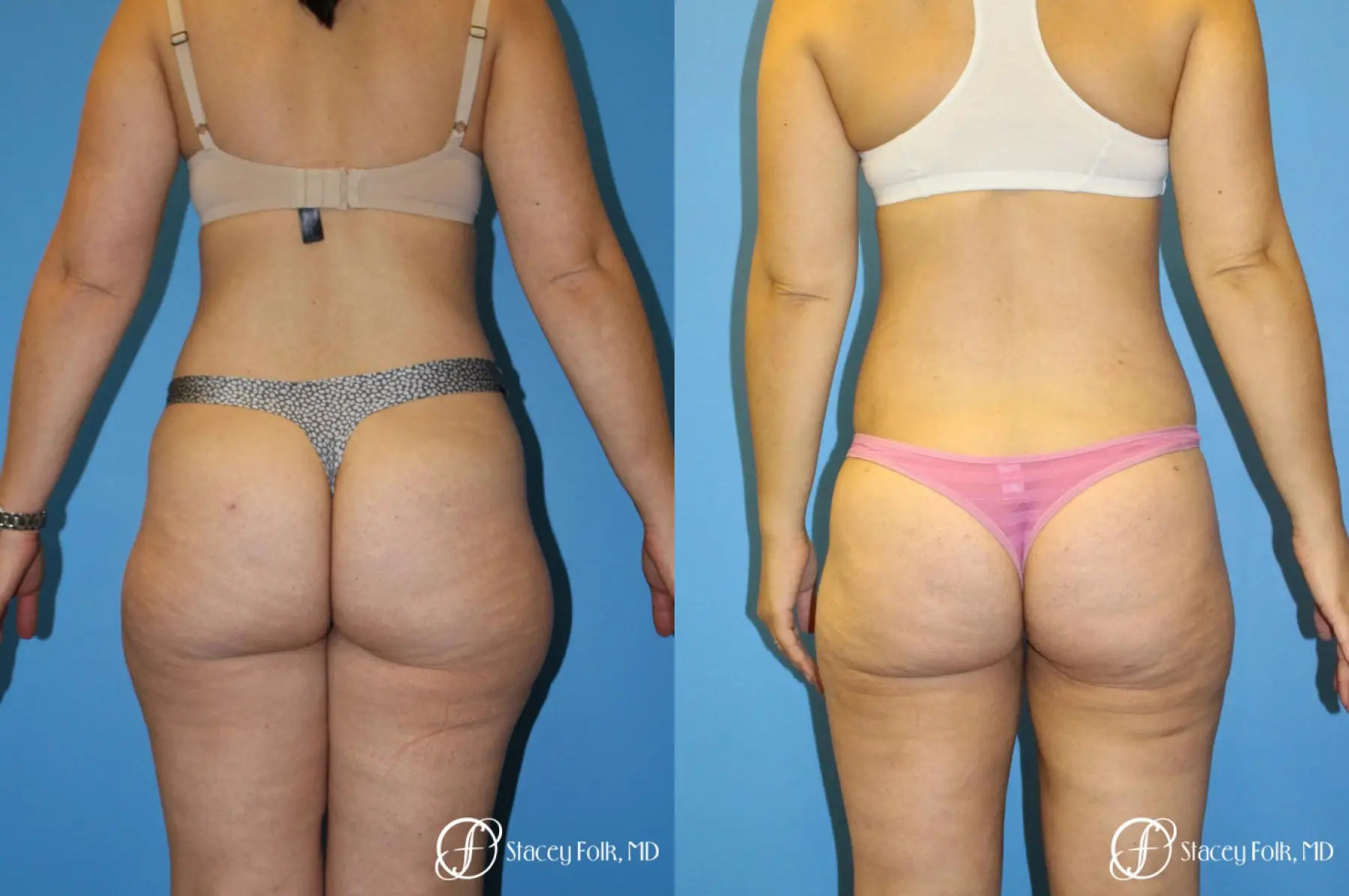 Liposuction - Stacey Folk, MD