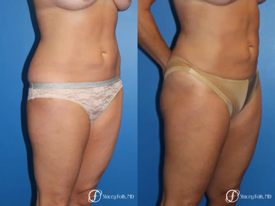Denver Liposuction 10267 - Before and After 3