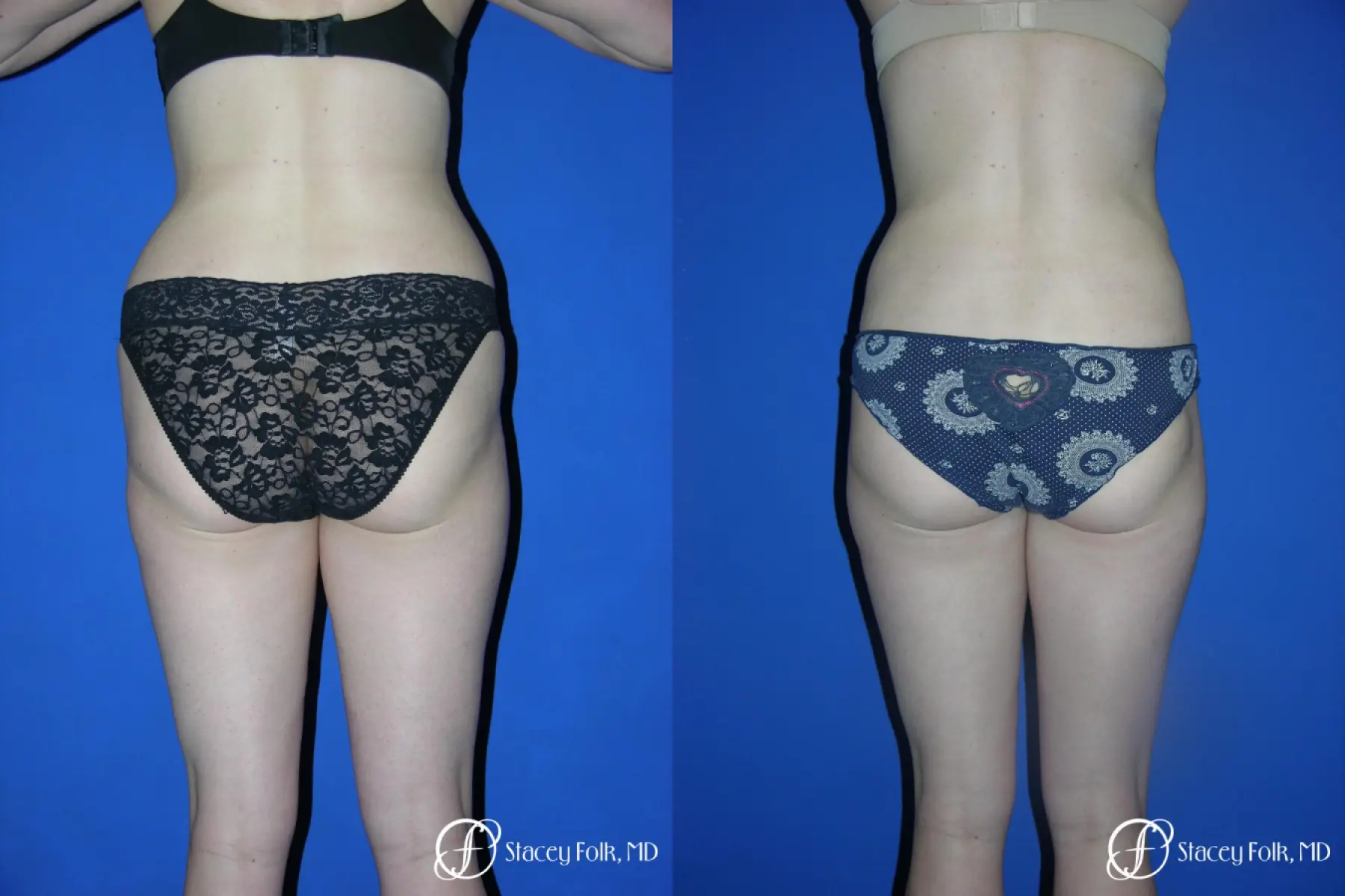 Denver Liposuction 961 - Before and After 2