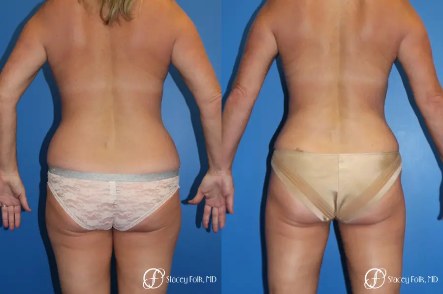 Denver Liposuction 10267 - Before and After 1