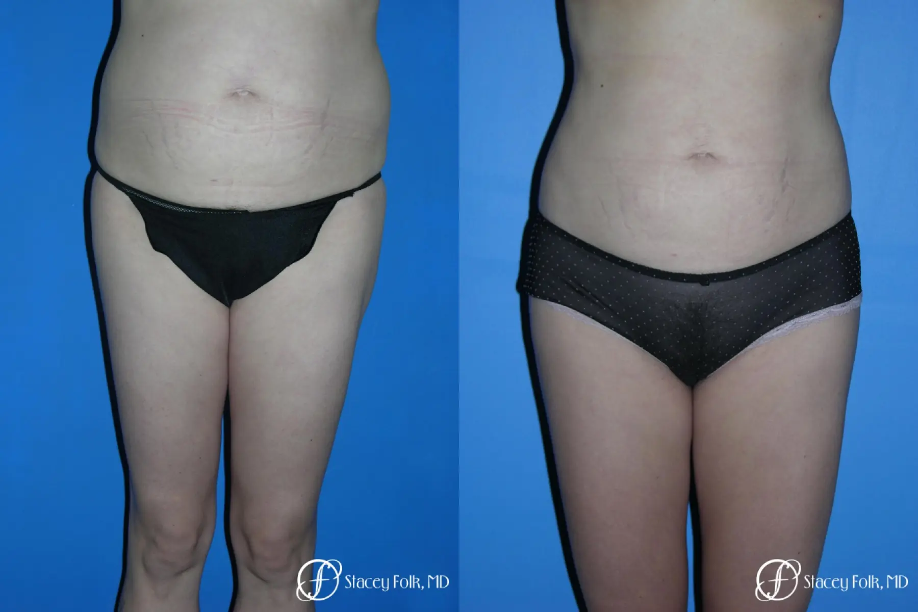 Denver Liposuction 3527 - Before and After 1