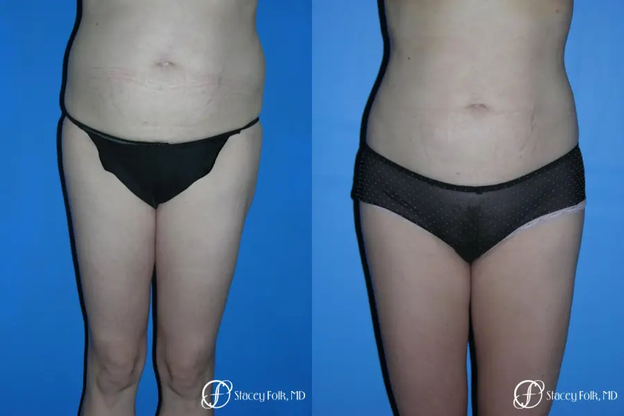 Denver Liposuction 3527 - Before and After