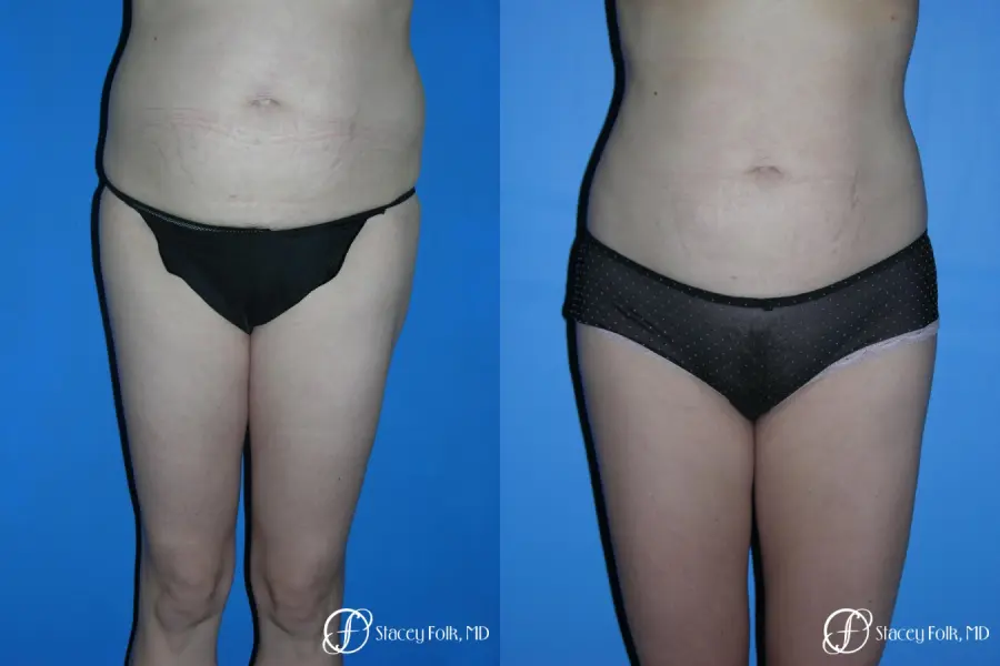 Denver Liposuction 3527 - Before and After 1