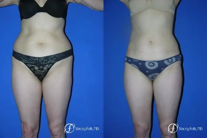 Denver Liposuction 961 - Before and After 1