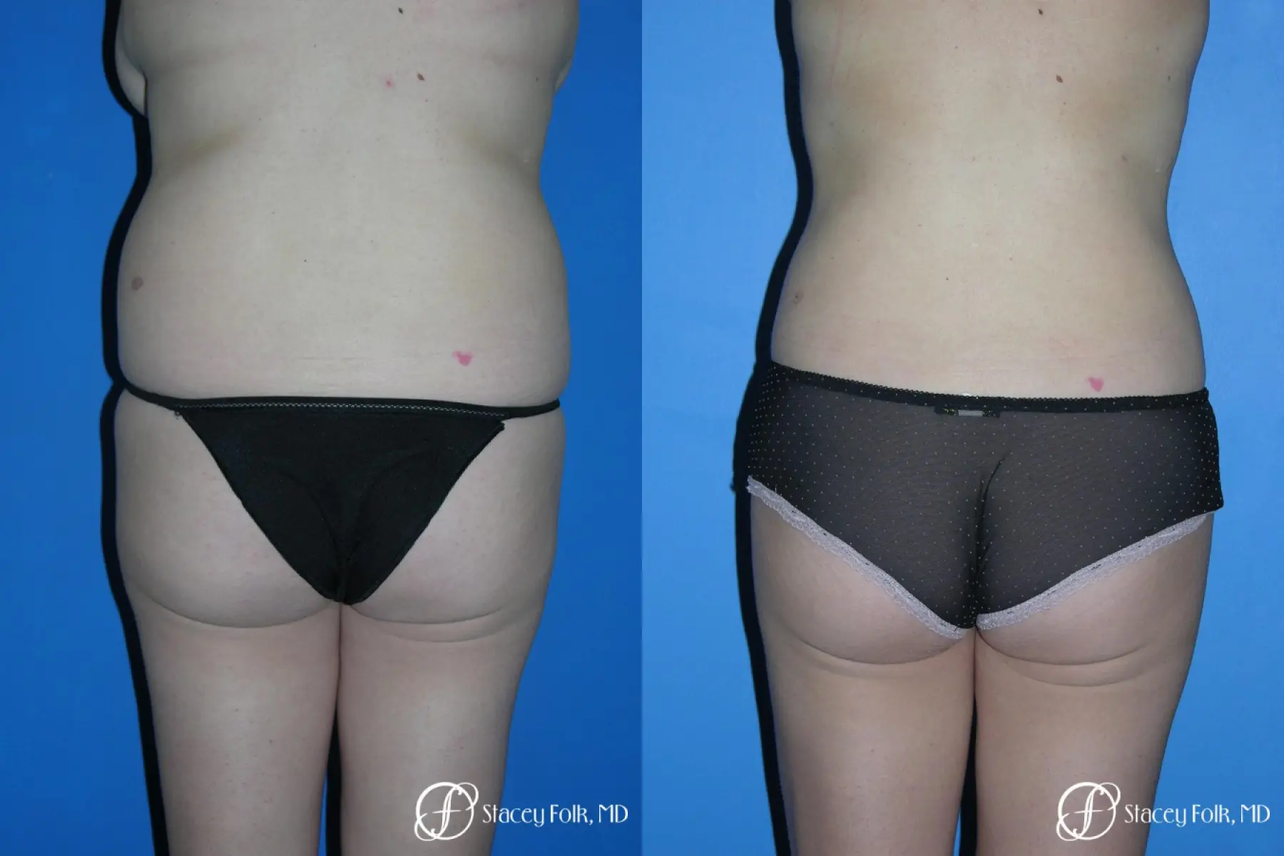 Denver Liposuction 3527 - Before and After 2