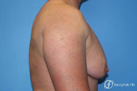 Denver FTM Female to male top surgery 5252 - Before Image 3