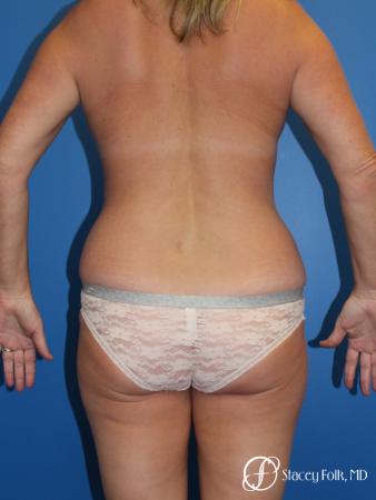Denver Liposuction 10267 - Before Image 1