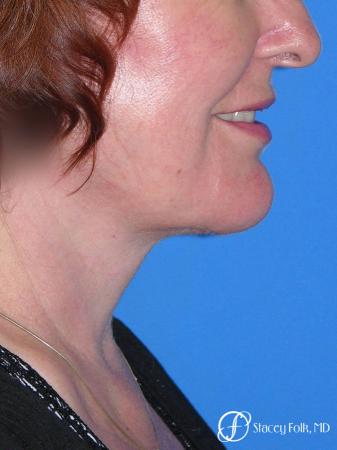 Denver Facial Rejuvenation Face lift, Fat Injections, Laser Resurfacing 7133 - After Image 1
