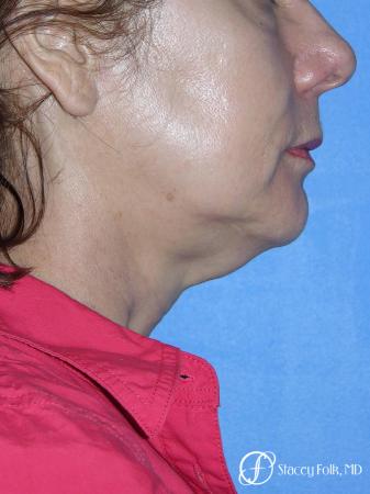 Denver Facial Rejuvenation Face Lift and Fat Injections 7117 - Before Image 1