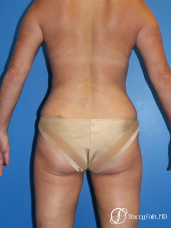 Denver Liposuction 10267 - After Image 1