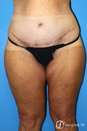 Denver Body Lift belt lipectomy, liposuction, mastopexy 5935 - After Image 1