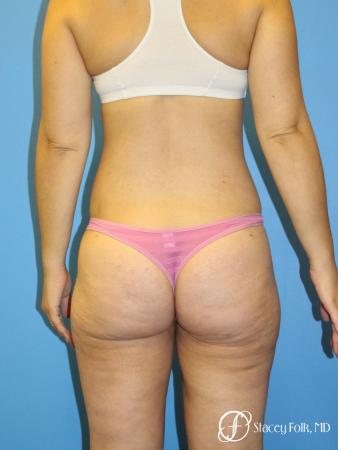 Denver Liposuction 8512 - After Image 1