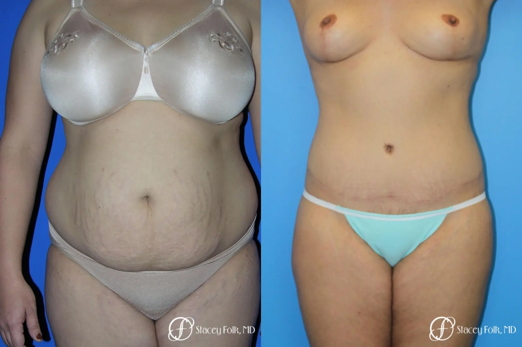 Denver Mommy makeover, breast reduction, abdominoplasty and liposuction 5353 - Before and After