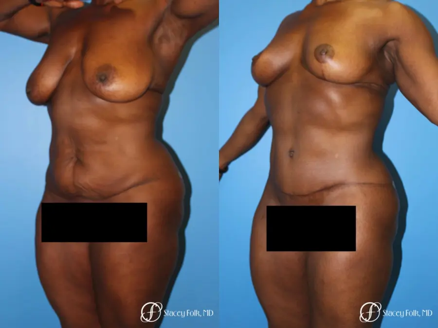 Denver Breast Lift - Mastopexy, and Tummy Tuck - Abdominoplasty 7512 - Before and After 2
