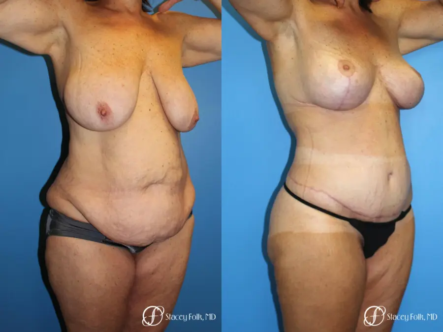 Denver Mommy Makeover Belt lipectomy, liposuction, mastopexy 5938 - Before and After 2