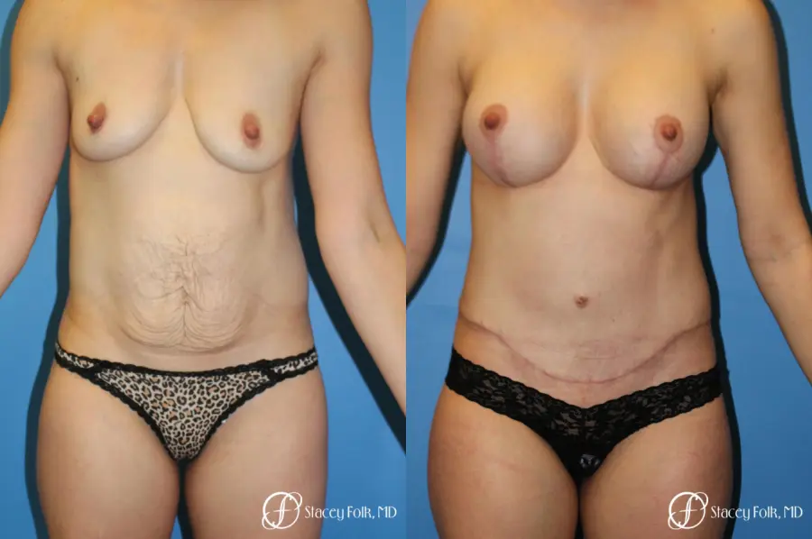 Denver Mommy Makeover 10376 - Before and After 1