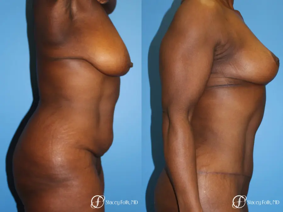 Denver Breast Lift - Mastopexy, and Tummy Tuck - Abdominoplasty 7512 - Before and After 4