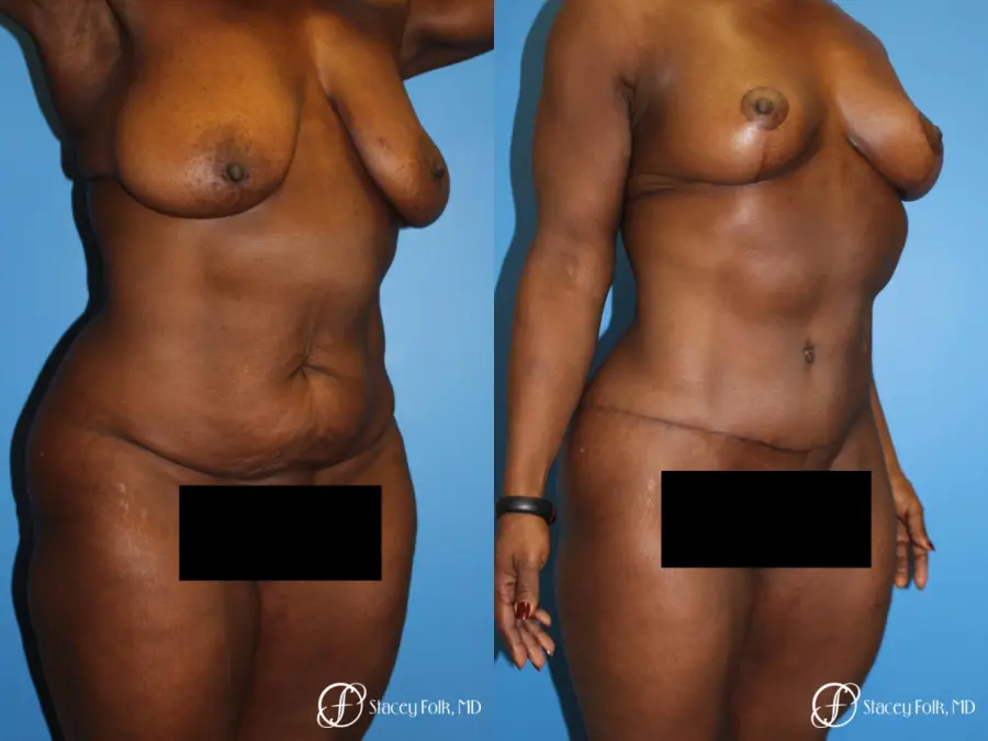 Denver Breast Lift - Mastopexy, and Tummy Tuck - Abdominoplasty 7512 - Before and After 3