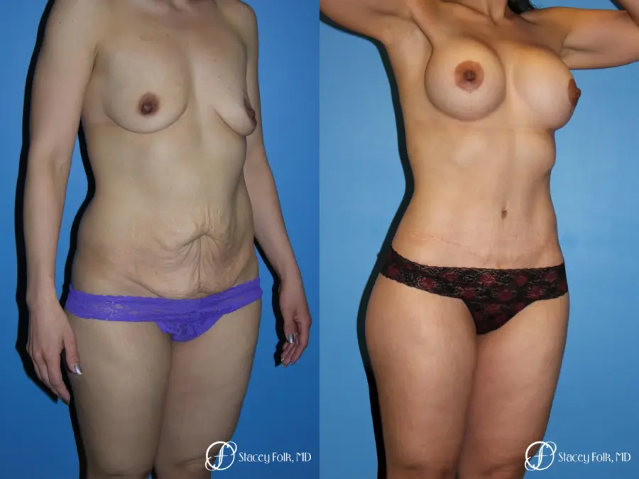 Denver Mommy makeover with a breast augmentation mastopexy and abdominoplasty 5352 - Before and After 2