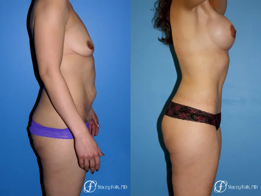 Denver Mommy makeover with a breast augmentation mastopexy and abdominoplasty 5352 - Before and After 3