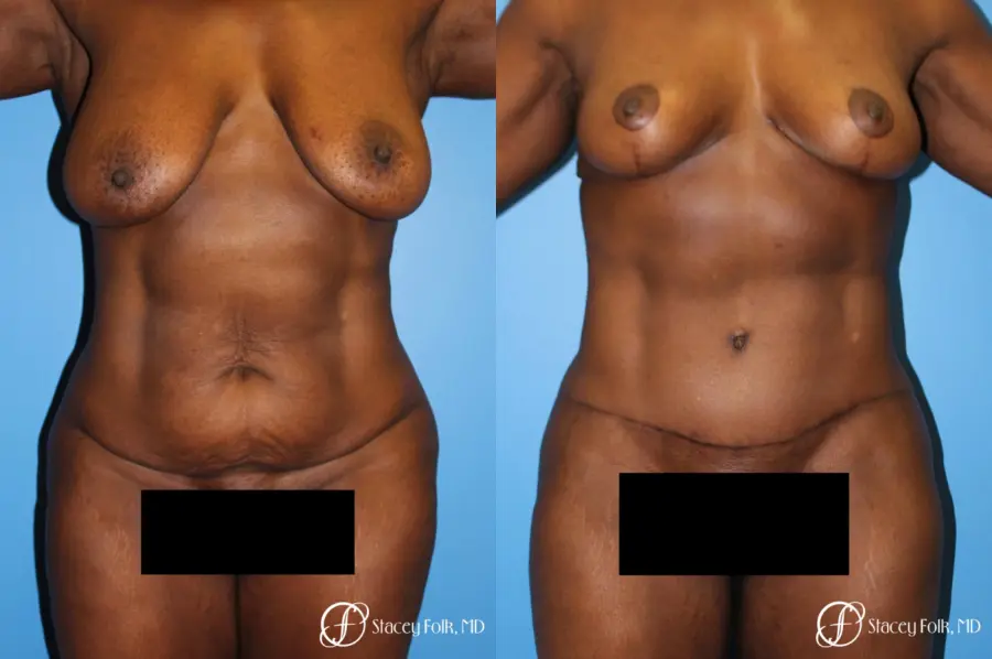 Denver Breast Lift - Mastopexy, and Tummy Tuck - Abdominoplasty 7512 - Before and After 1