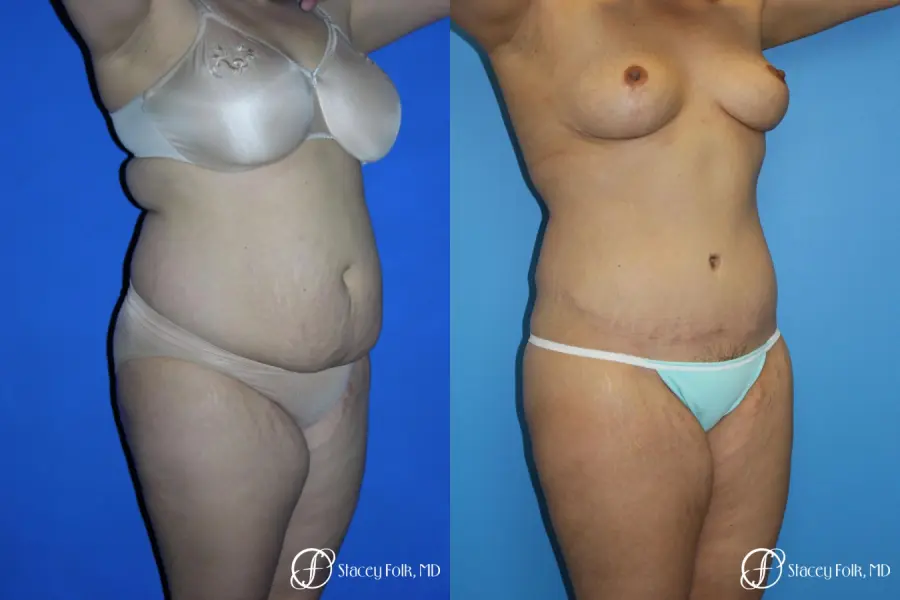 Denver Mommy makeover, breast reduction, abdominoplasty and liposuction 5353 - Before and After 2
