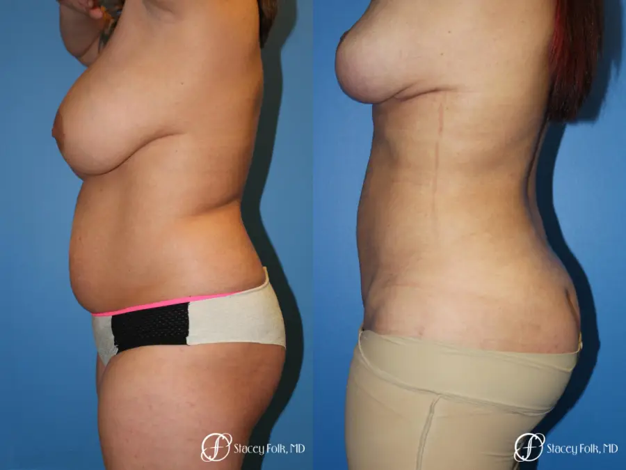 Denver Mommy Makeover 10298 - Before and After 2
