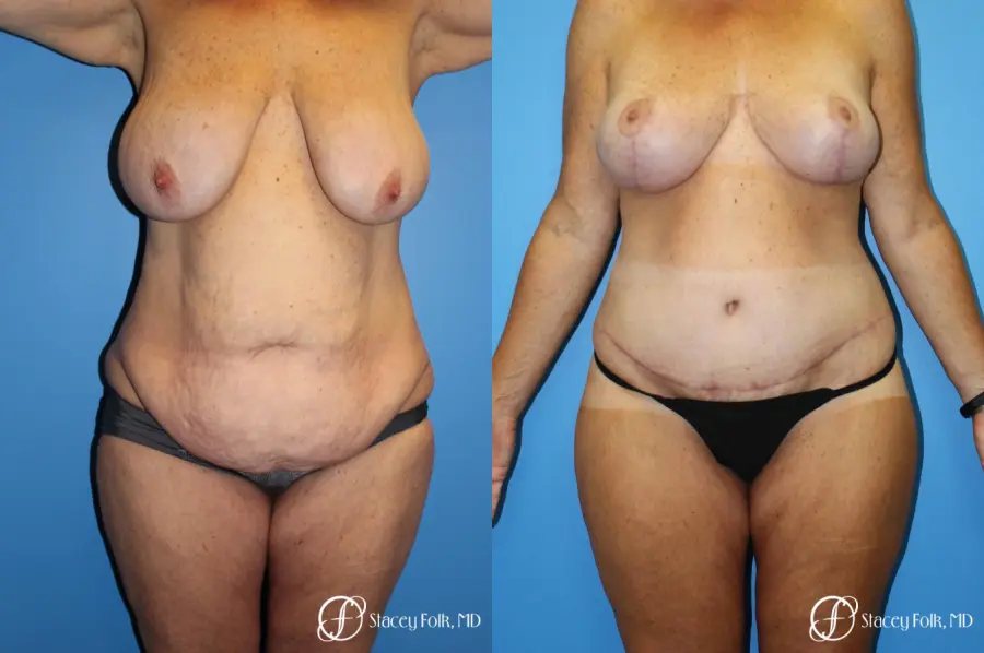 Denver Mommy Makeover Belt lipectomy, liposuction, mastopexy 5938 - Before and After 1