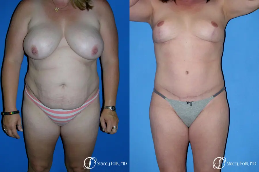 Denver Mommy makeover, breast reduction, abdominoplasty, liposuction 5355 - Before and After