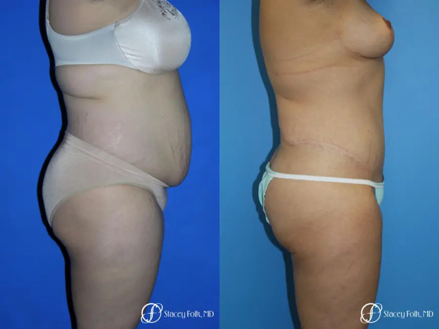 Denver Mommy makeover, breast reduction, abdominoplasty and liposuction 5353 - Before and After 3