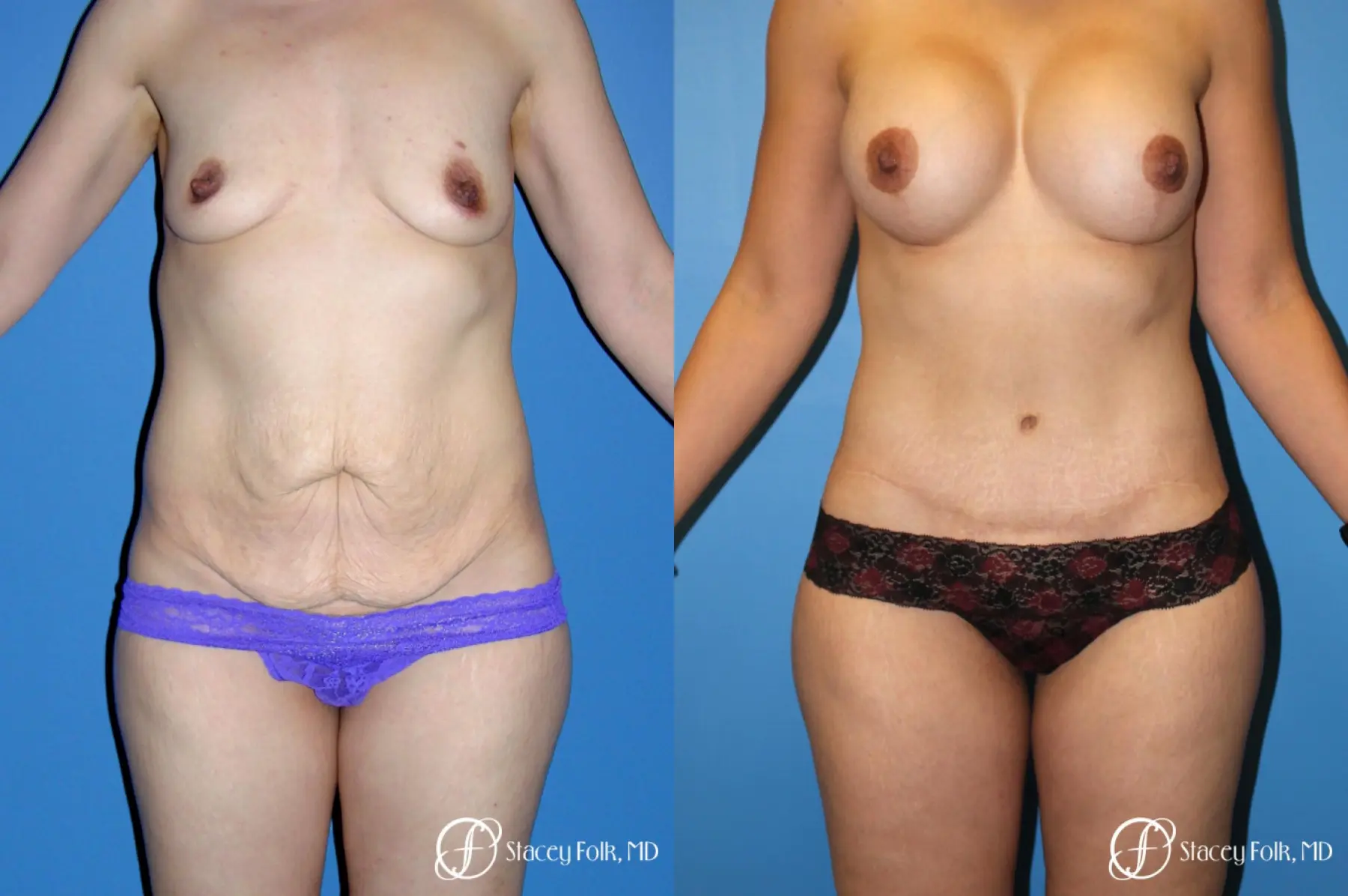 Denver Mommy makeover with a breast augmentation mastopexy and abdominoplasty 5352 - Before and After