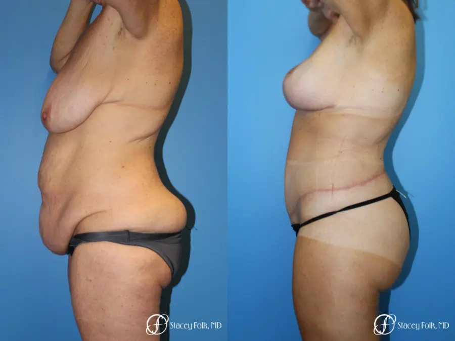 Denver Mommy Makeover Belt lipectomy, liposuction, mastopexy 5938 - Before and After 3