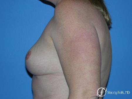 Denver Breast Reduction 4790 - After Image 5