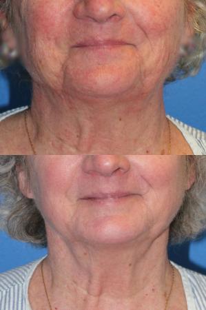 Denver J-Plasma Face Laser resurfacing with J-Plasma 10864 - Before Image 1