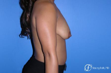 Denver Breast augmentation mastopexy 4815 - Before and After Image 3