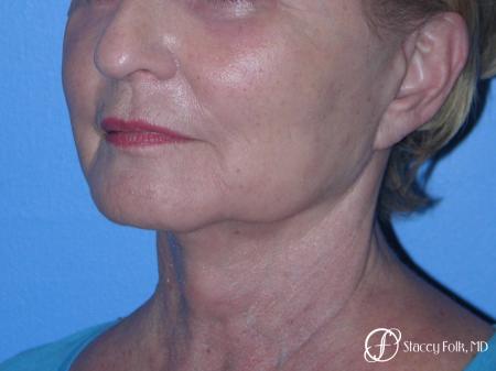 Denver Facial Rejuvenation Face Lift, Fat Injections, and Laser Resurfacing 7120 - After Image 2