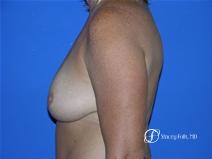 Denver Breast Reduction 14 - After Image 3
