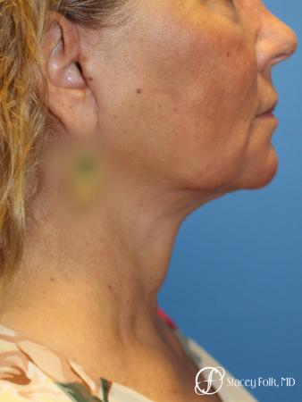 Denver Facial Rejuvenation Face Lift, Fat Injection, Laser Resurfacing 7123 - After Image 1