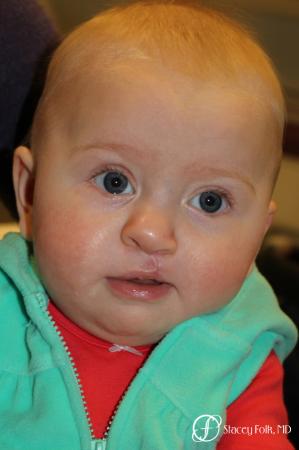 Denver Cleft lip and palate repair 9363 - After Image 1