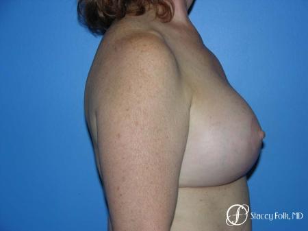 Denver Breast Lift - Mastopexy 7977 - After Image 3