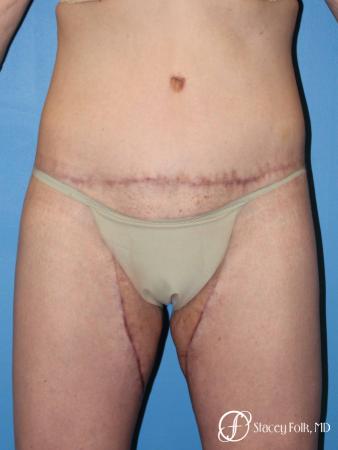 Denver Body Lift Belt lipectomy 5268 - After Image 1