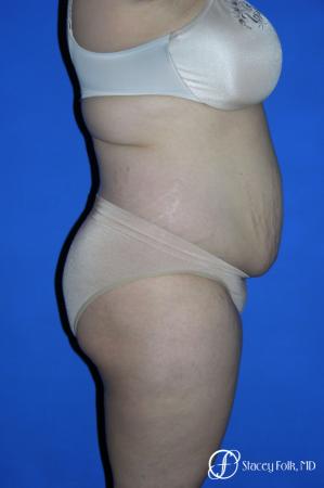 Denver Mommy makeover, breast reduction, abdominoplasty and liposuction 5353 - Before and After Image 3